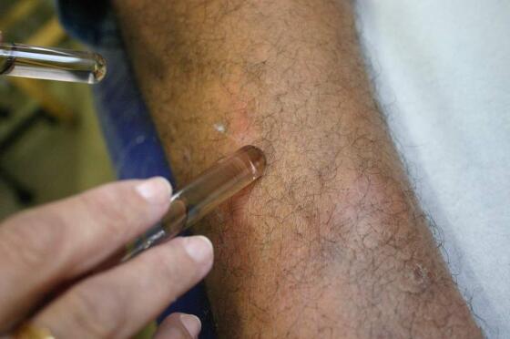 SES avança em ações de enfrentamento à hanseníase em Mato Grosso