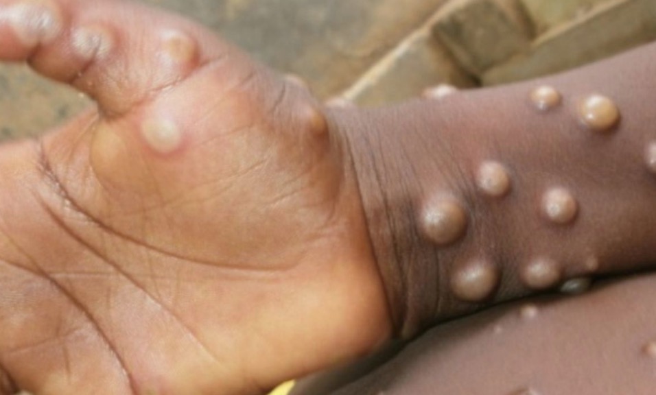 Secretaria de Saúde confirma 20 casos de varíola dos macacos em MT