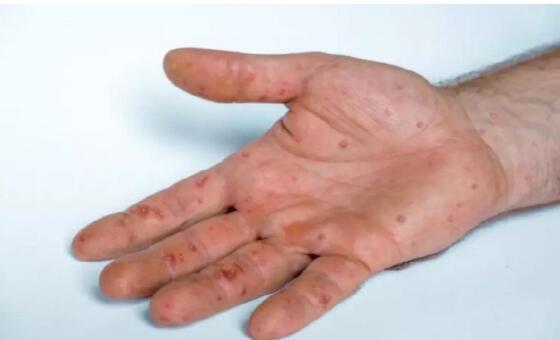 Fim de semana registra 9 novos casos de monkeypox em MT