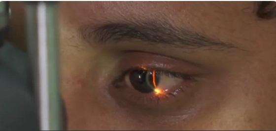 Com a umidade do ar baixa em MT, doenças como conjuntivite podem se manifestar